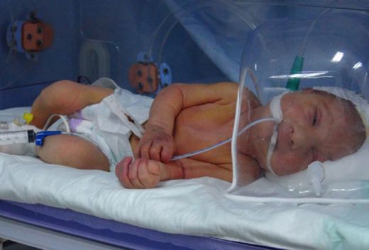yeni dogan bebeklerde solunum yetmezligi belirtileri ve tedavisi